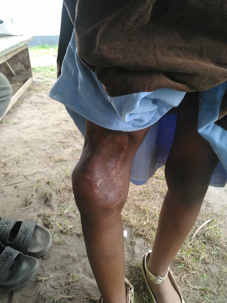 Busayo's deep scar after surgical intervention.