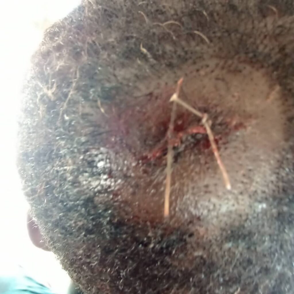 The victim's injured head after being brutalised by OP-MESA