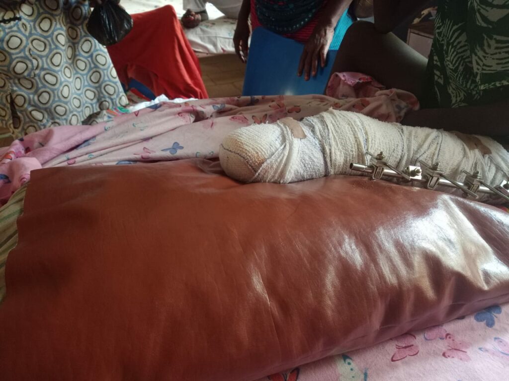 The amputated leg on the hospital bed at FTH Ido-Ekiti