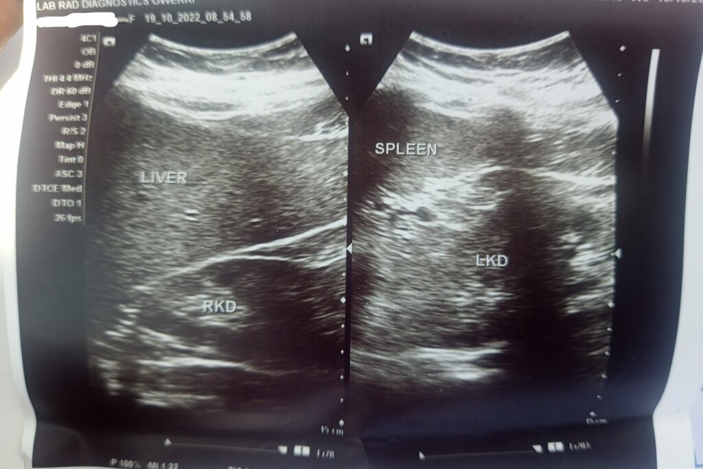 Rose's ultrasound result