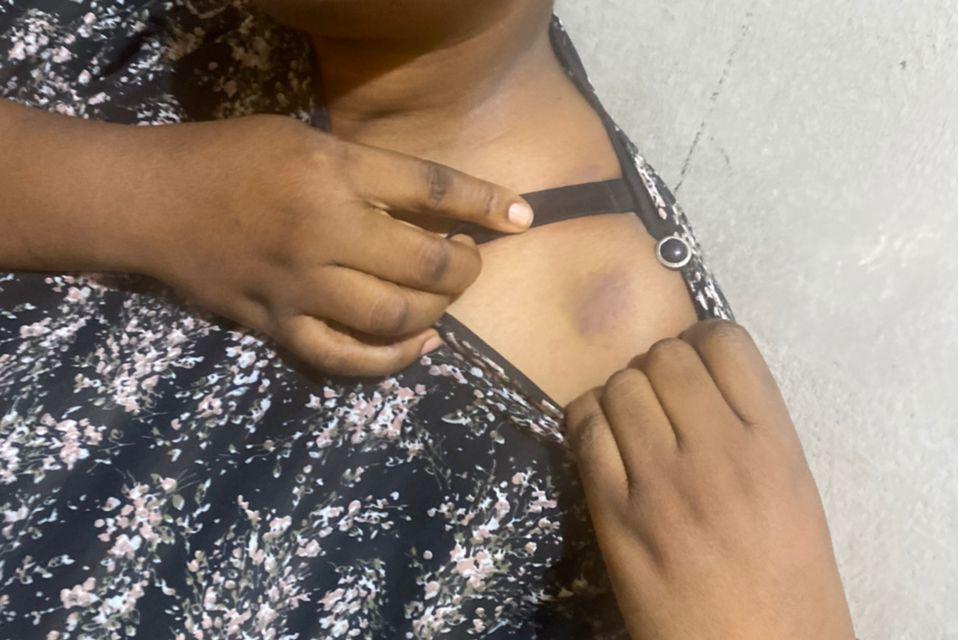 Zainab's bruised shoulder, one week after