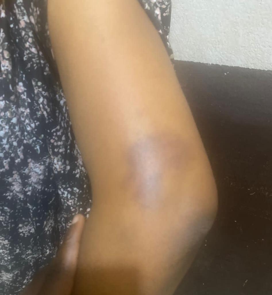 Zainab's injured arm