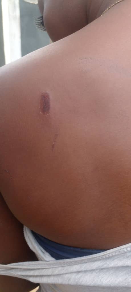 Aghama's bruised body
