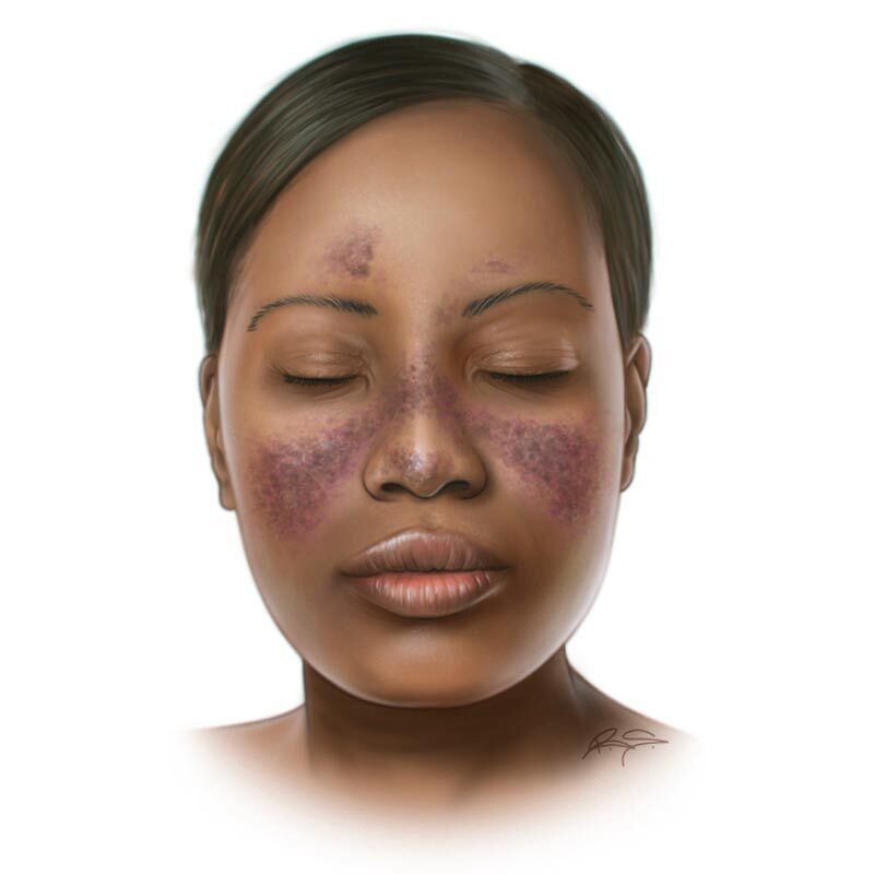 What lupus rashes look like