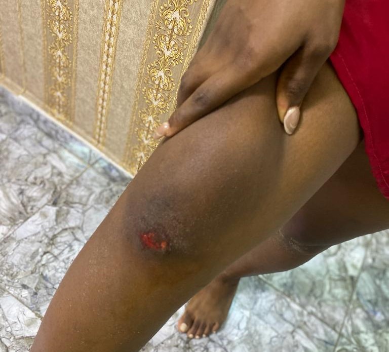 Prudence's bruised knee