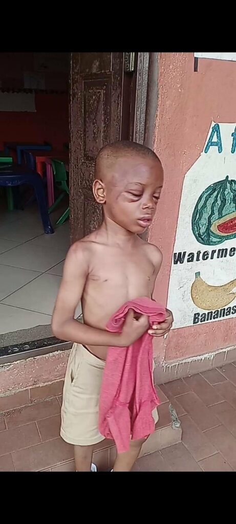 Injury inflicted on 5-year-old boy